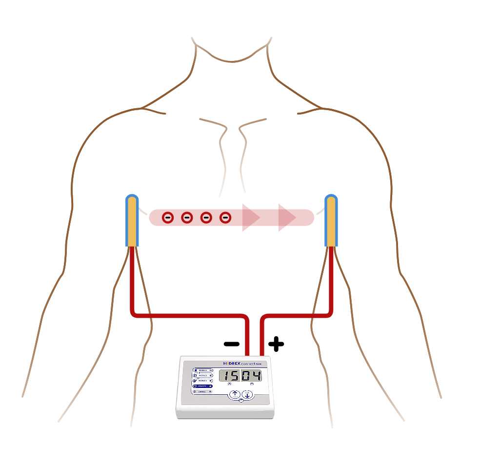 Achselbehandlung mit der Iontophorese - schematische Darstellung